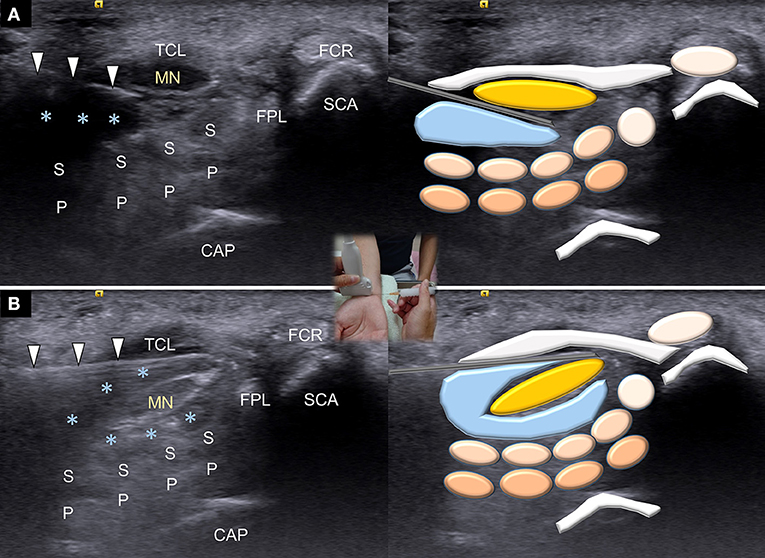 Frontiers | Ultrasound-Guided Triamcinolone Acetonide Hydrodissection for Carpal Tunnel Syndrome: A Randomized Controlled Trial