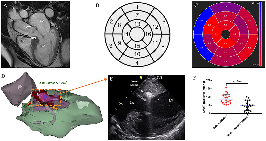 Frontiers  Selective Interventricular Septal Radiofrequency Ablation in  Patients With Hypertrophic Obstructive Cardiomyopathy: Who Can Benefit?