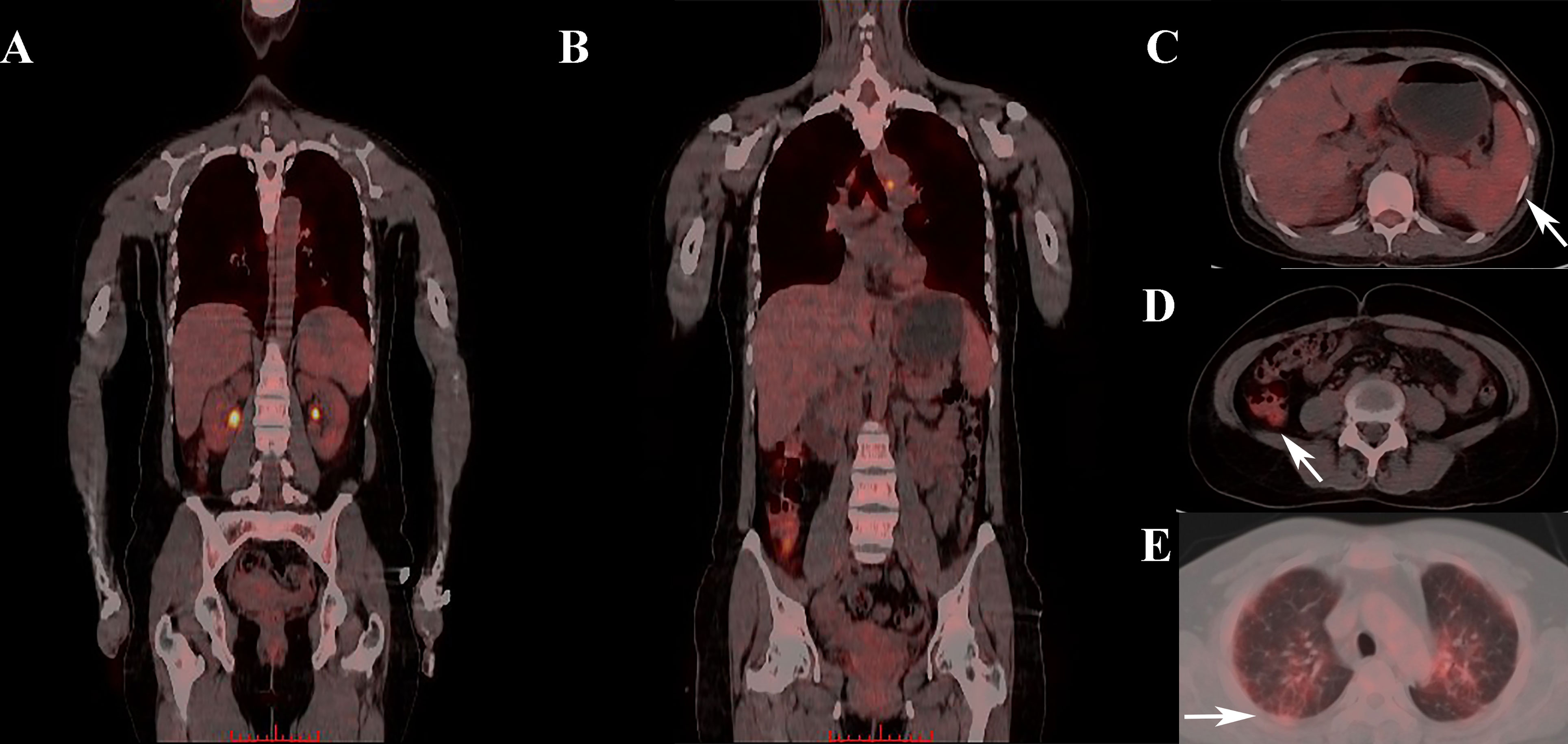 Frontiers Clinical Value Of 18f Fdg Petct Scan And Cytokine Profiles