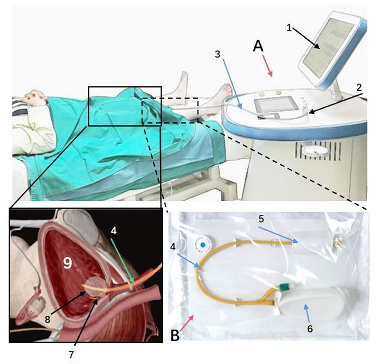 PDF) Conventional radiofrequency treatment in five patients with