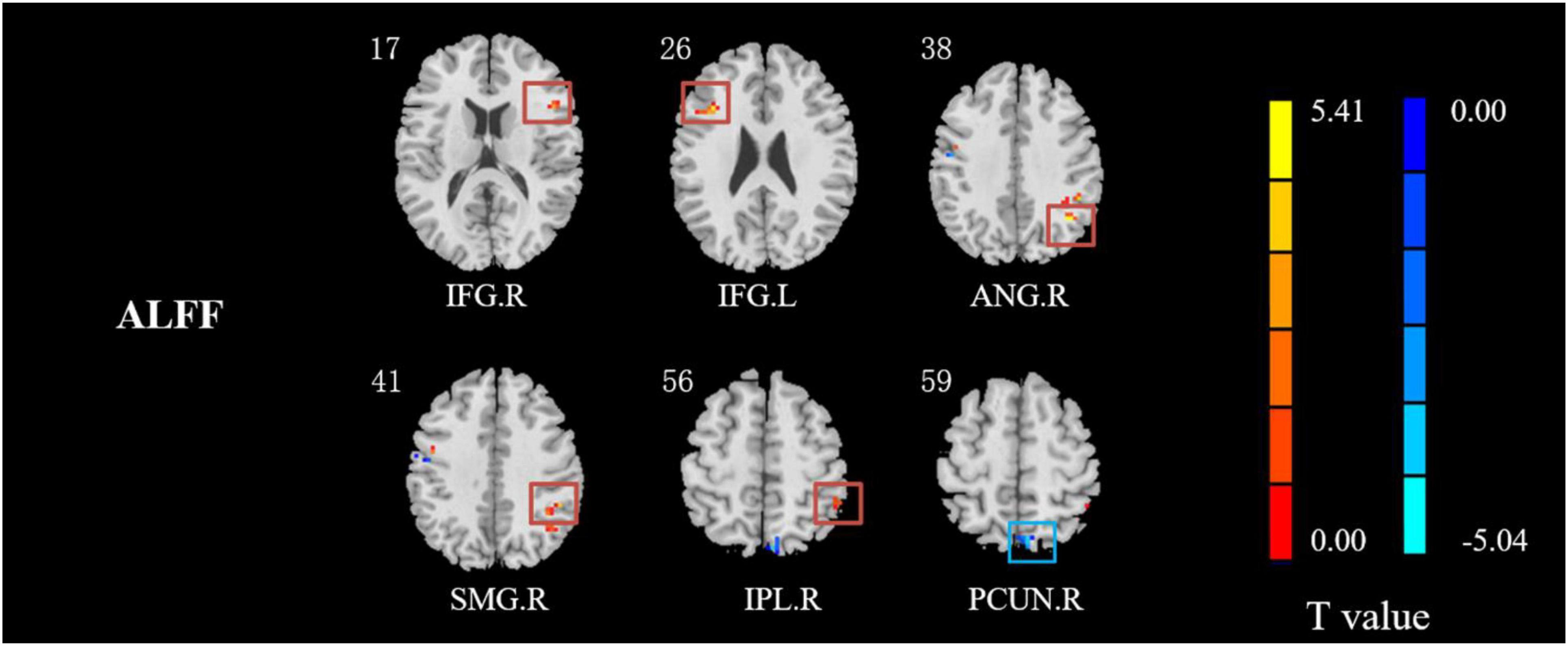 Frontiers  Altered Spontaneous Brain Activity Patterns and Functional  Connectivity in Adults With Intermittent Exotropia: A Resting-State fMRI  Study