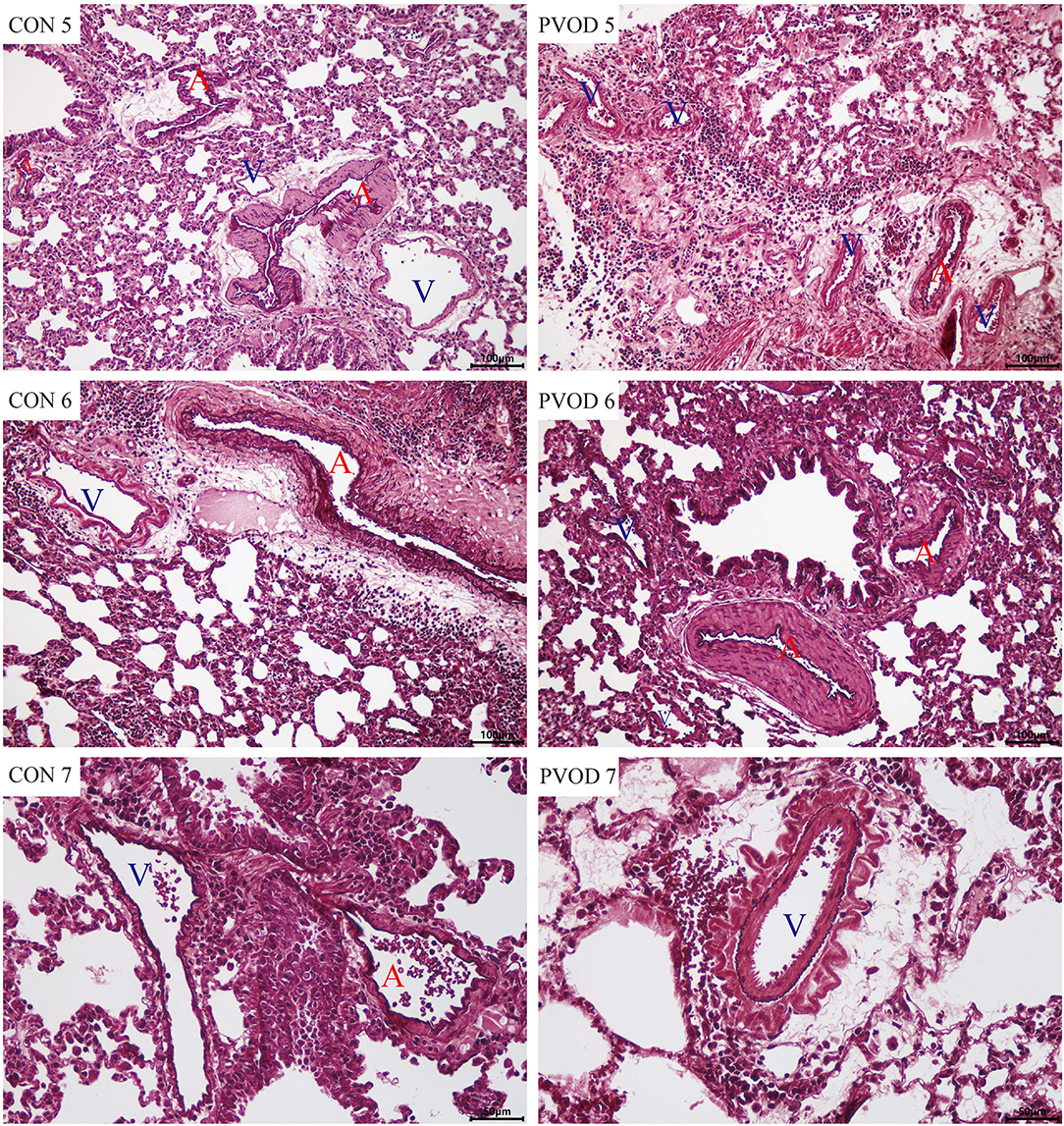 Frontiers Differential Expression Profile of microRNAs and Tight Junction in the Lung Tissues of Rat With Mitomycin-C-Induced Pulmonary Veno-Occlusive Disease