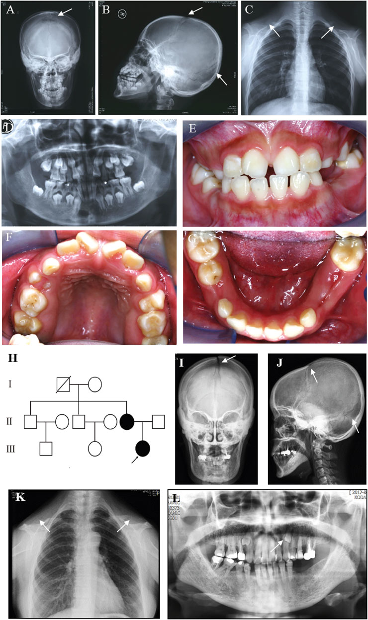 X-ray Marker Parker STUDENT BONES 