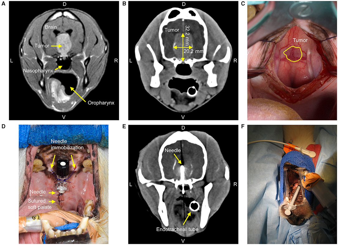Frontiers  Outcome of giant pituitary tumors requiring surgery