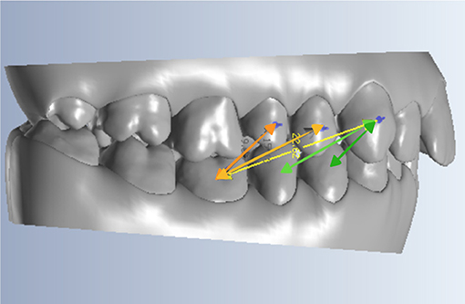 A Colorful Perspective About Braces Rubber Band Elastics