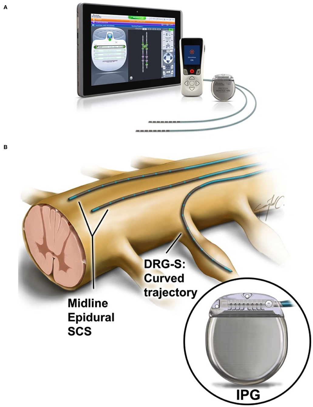 Spinal cord stimulation