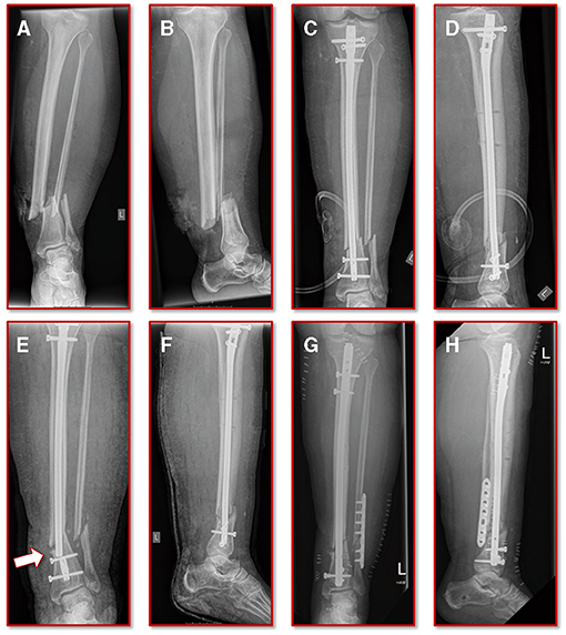 Patient with tibia nonunion. a X-ray from the pre-treatment period