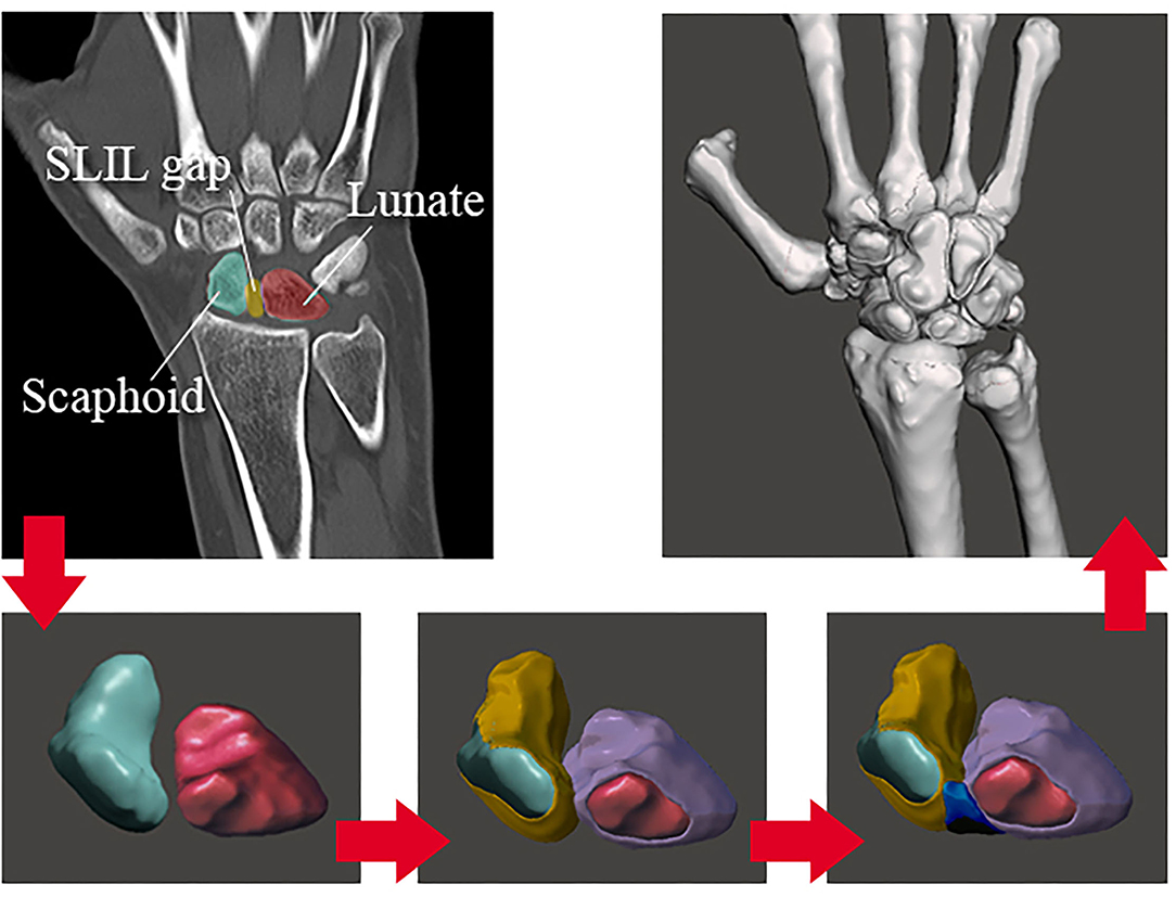 Stability of different fixation methods after reduction malarplasty under  average and maximum masticatory forces: a finite element analysis, BioMedical Engineering OnLine