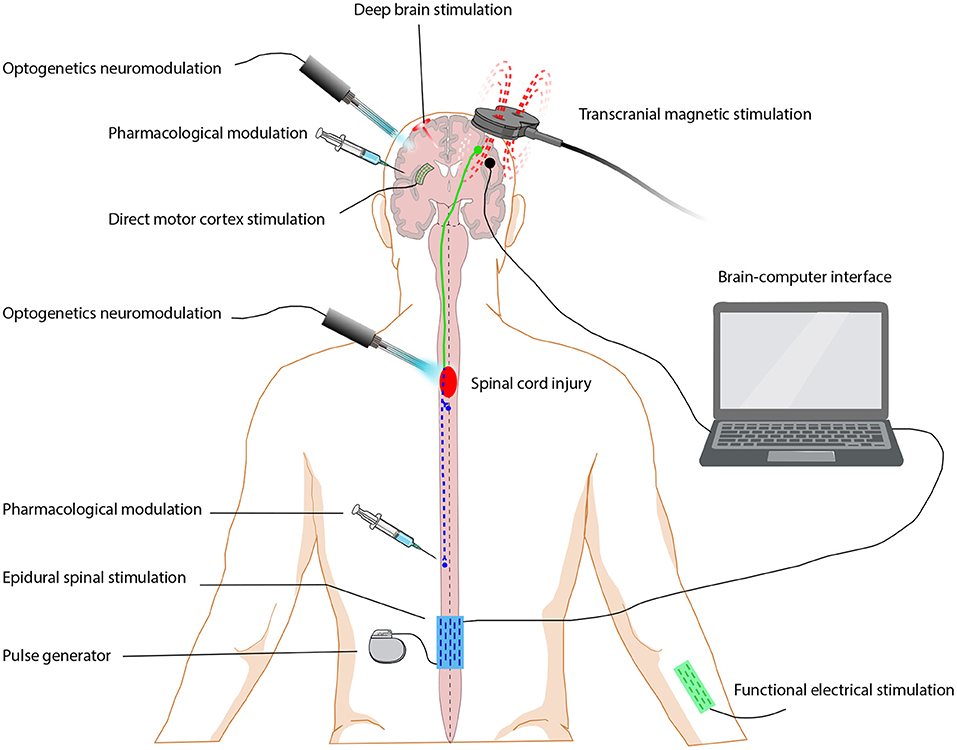 Spinal Cord Stimulation, CorTec