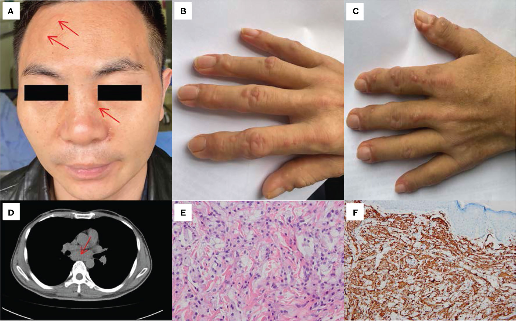Frontiers | Case Report: Multicentric Reticulohistiocytosis ...