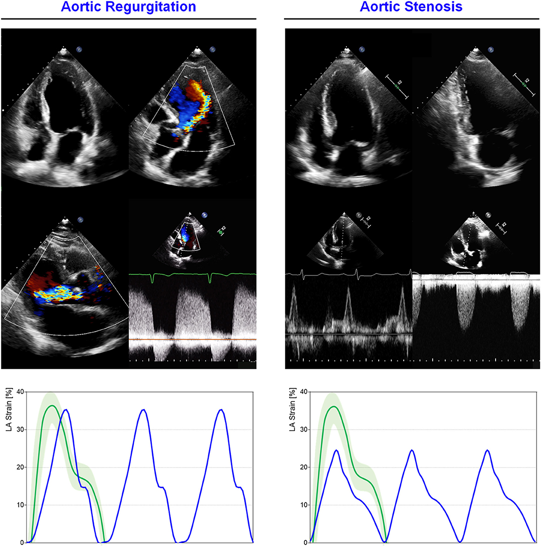 Prognostic Utility of Echocardiographic Atrial and Ventricular Strain  Imaging in Patients With Cardiac Amyloidosis