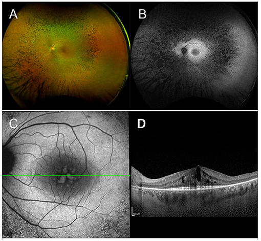 abnormal Amsler Grid test- Retina Ophthalmology Gettysburg PA & Frederick  MD - Greater Potomac Retina - Greater Potomac Retina