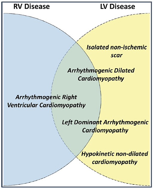 Left Ventricular Dysfunction in Arrhythmogenic Cardiomyopathy: Association  With Exercise Exposure, Genetic Basis, and Prognosis