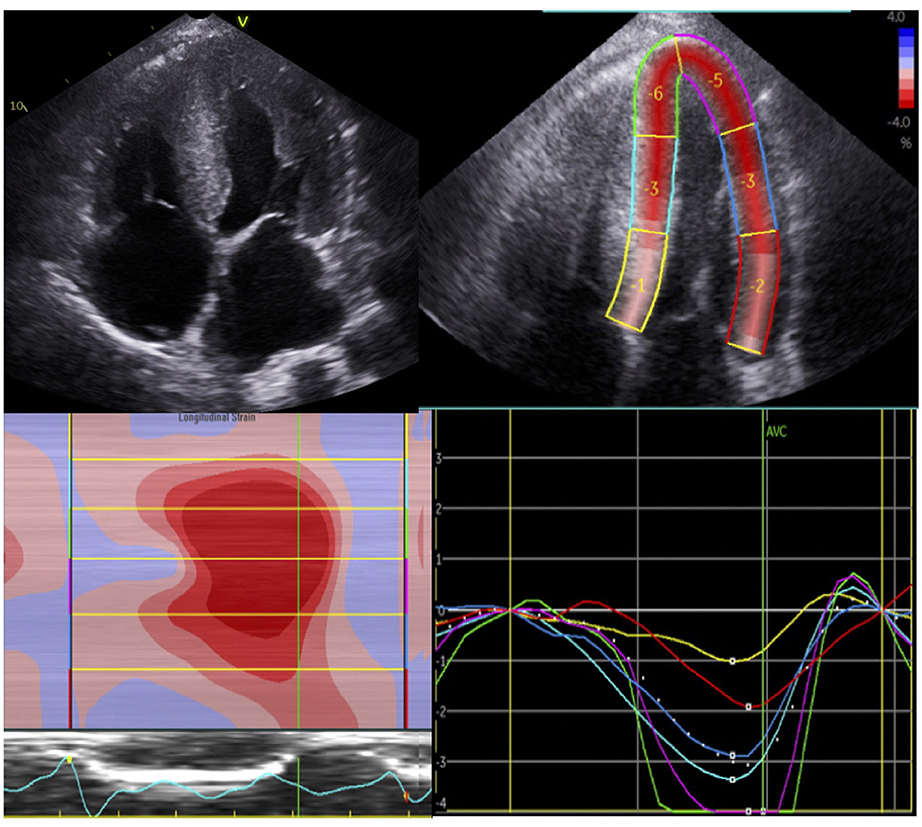 Efficacy of echocardiography for differential diagnosis of left ventricular  hypertrophy: special focus on speckle-tracking longitudinal strain