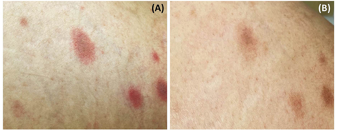 Frontiers Case Report Pityriasis Rosea Like Eruption Following Covid