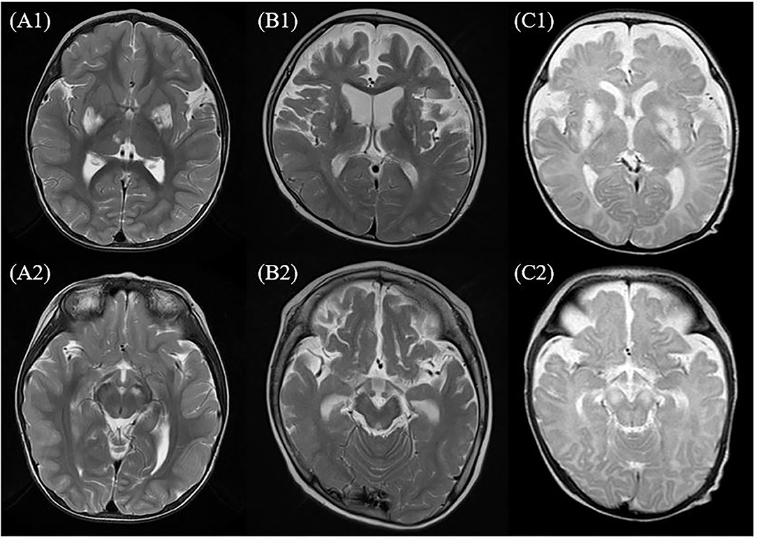 Frontiers | Association Between Epilepsy and Leigh Syndrome With MT-ND3 ...