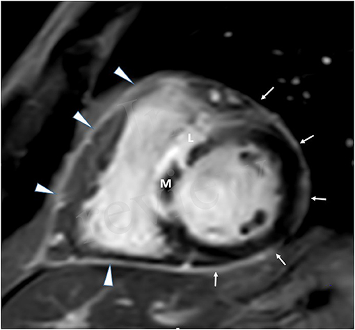 Frontiers | Pericardial Involvement in ST-Segment Elevation Myocardial  Infarction as Detected by Cardiac MRI