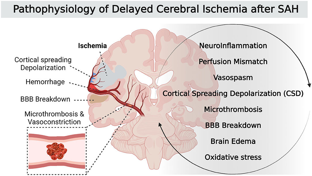 Frontiers  Delayed Cerebral Ischemia After Subarachnoid