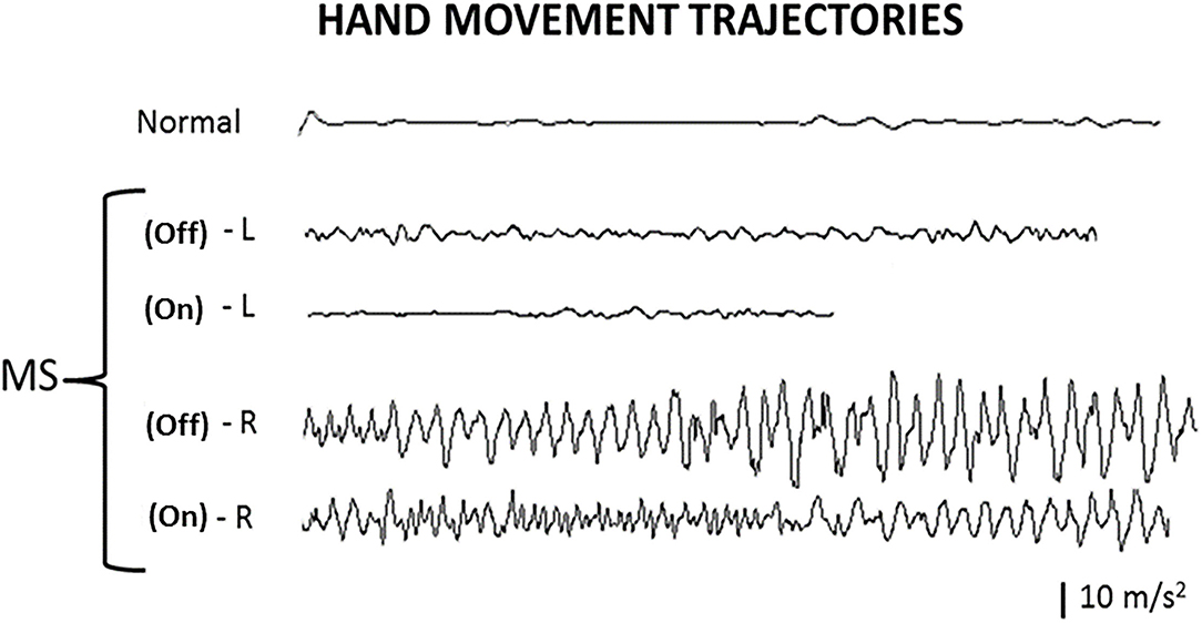 Frontiers | Effect of Deep Brain Stimulation on Cerebellar Tremor ...