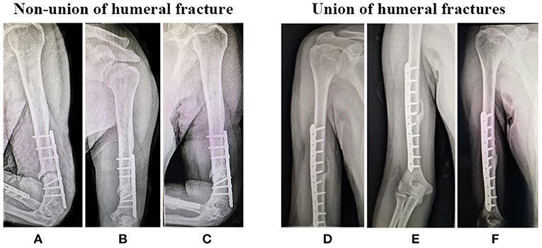 Frontiers | Analysis of Risk Factors for Non-union After Surgery for Limb  Fractures: A Case-Control Study of 669 Subjects
