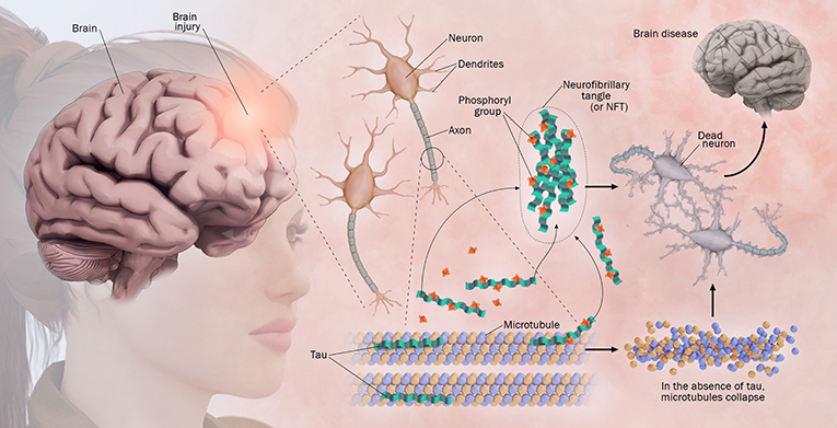 Figure 3 - When the brain is injured, tau proteins may attach themselves to phosphoryl groups, leaving the microtubules to form NFTs.