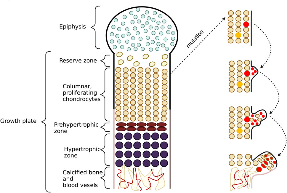 Hereditary multiple exostoses with spinal cord compression.