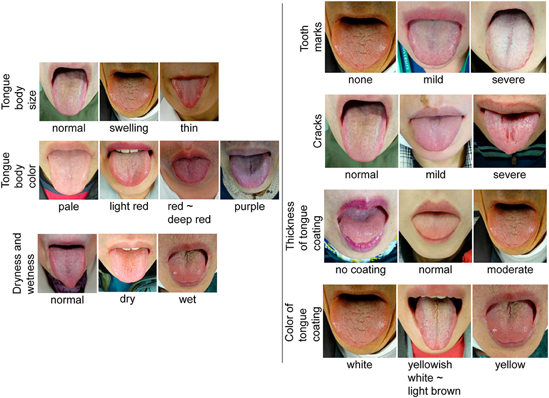 normal tongue coating