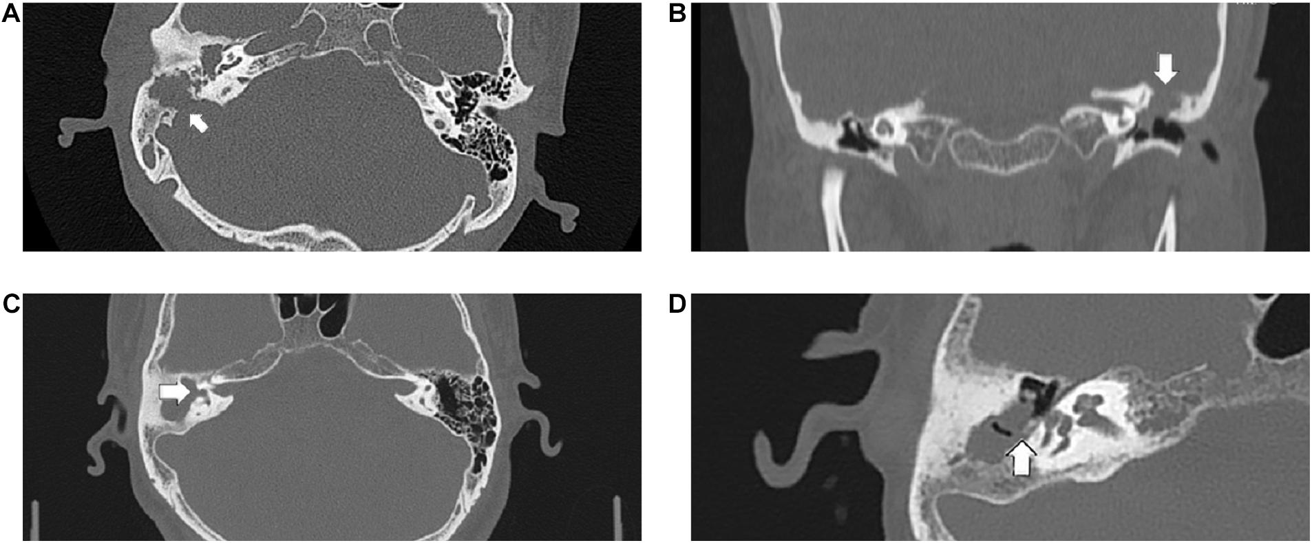 Tympanosclerosis – Oto Surgery Atlas