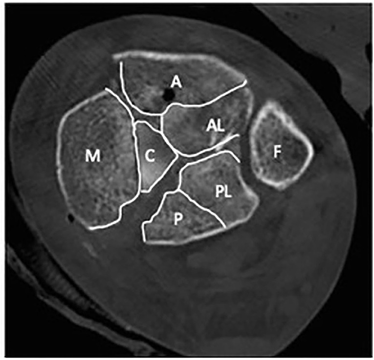 Analysis of bone transport for ankle arthrodesis as a limb salvage  procedure for the treatment of septic pilon fracture nonunion