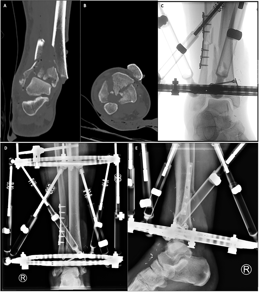 TIBIA BY HYBRID FIXATION