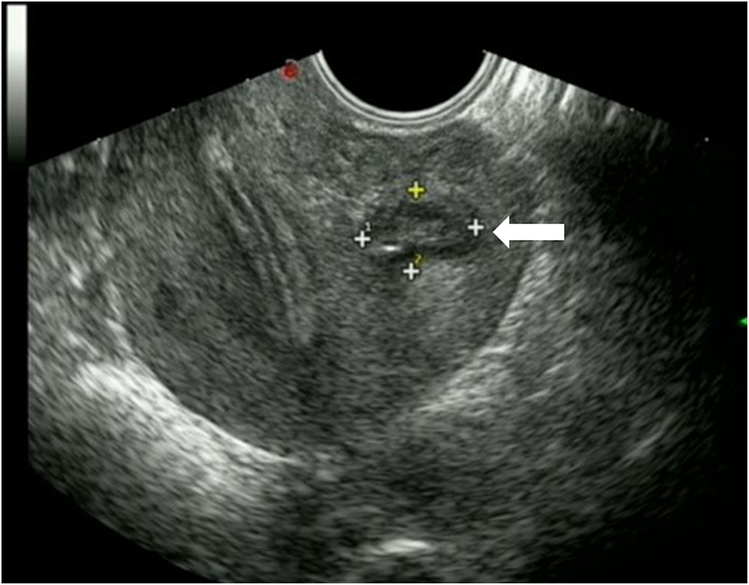 Frontiers Ultrasound Guided Transvaginal Aspiration And Sclerotherapy Hot Sex Picture