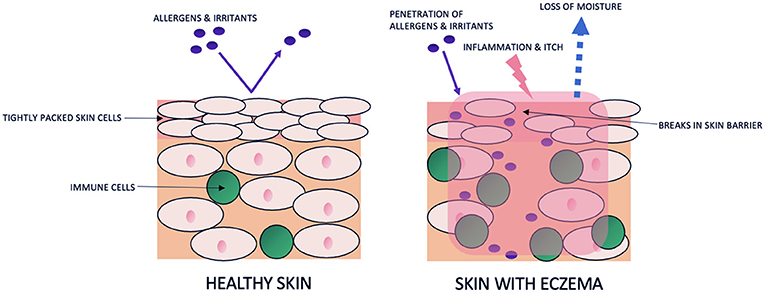 Figure 1 - Healthy skin vs. skin with eczema.