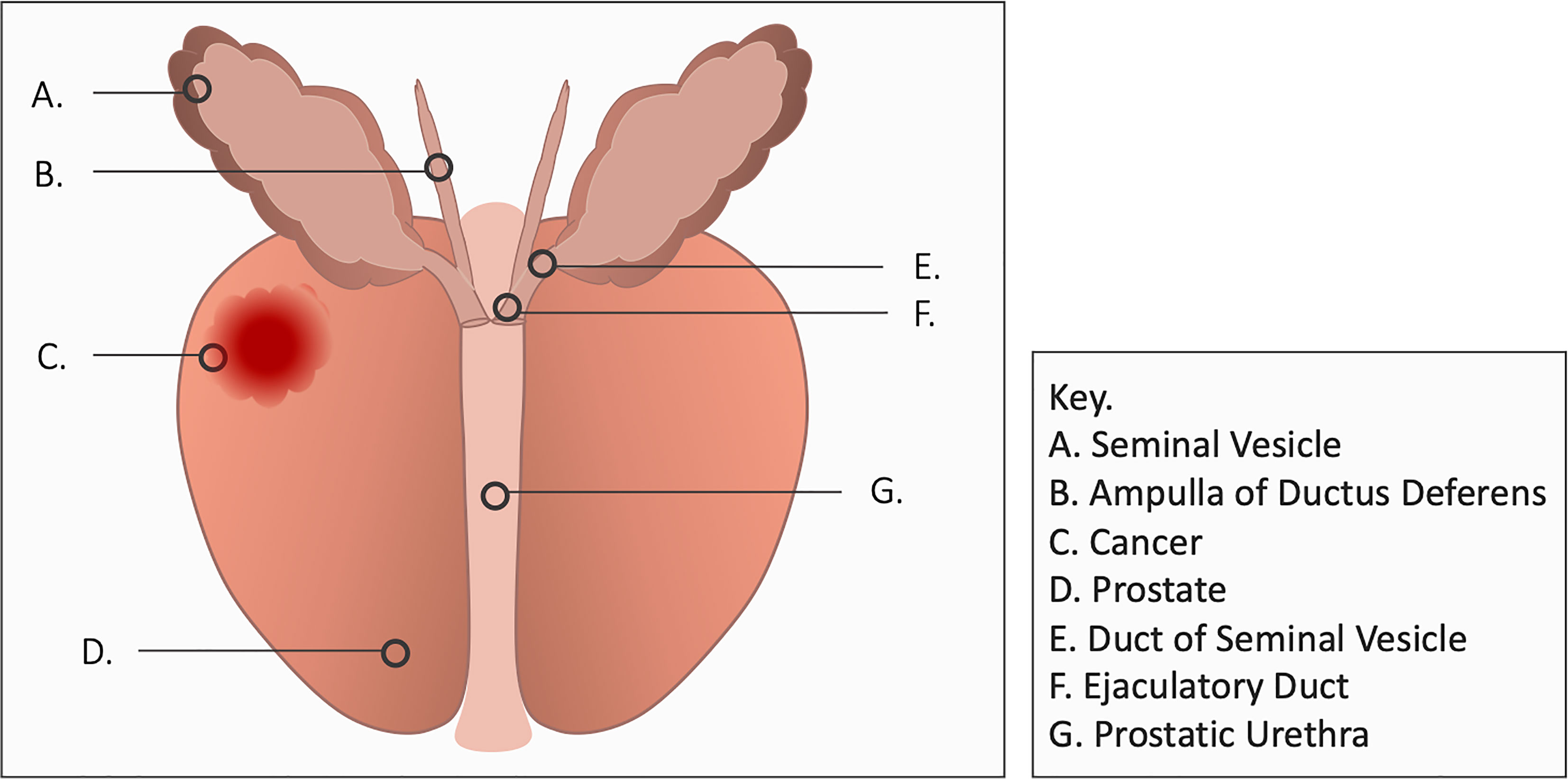 Frontiers | Bothersome Hematospermia Following Stereotactic Body ...