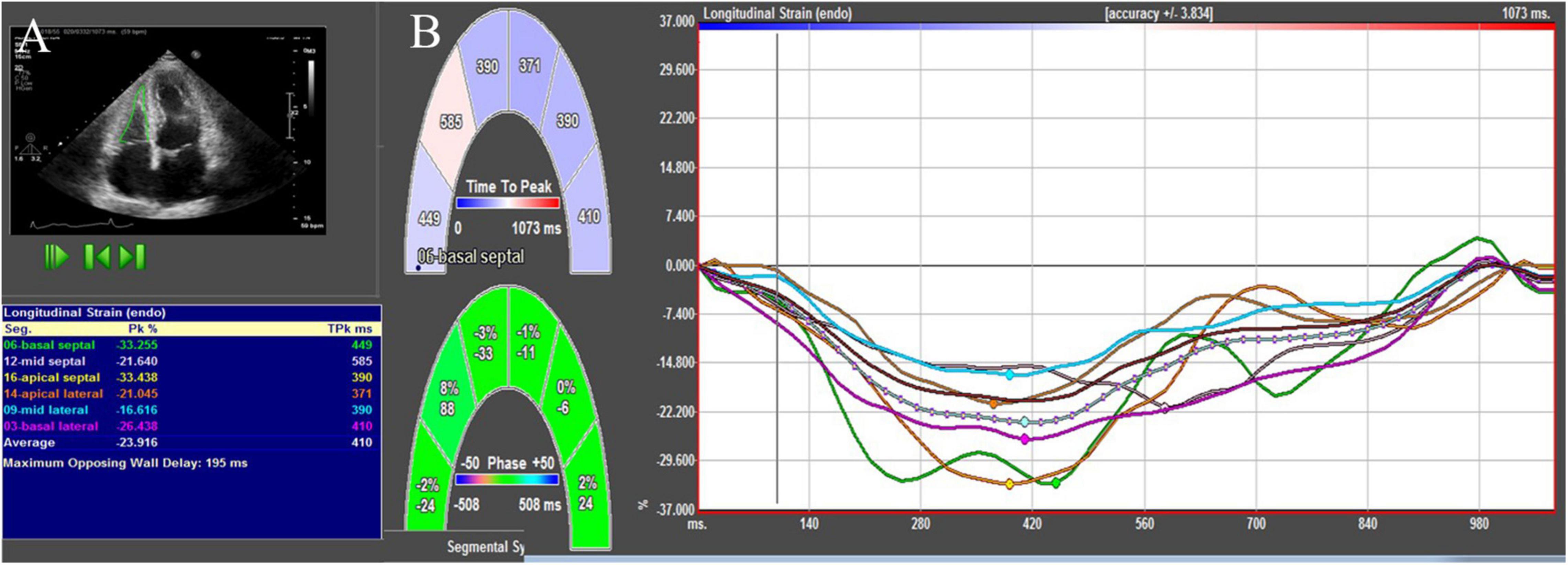 Strain, strain rate and speckle tracking: Myocardial deformation