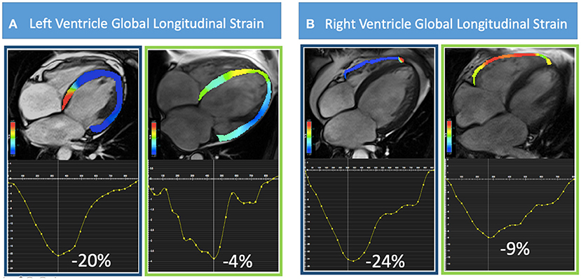Frontiers  Prognostic Significance of Feature-Tracking Right Ventricular Global  Longitudinal Strain in Non-ischemic Dilated Cardiomyopathy