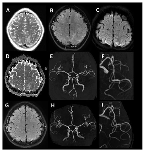 Subarachnoid hemorrhage  Radiology Reference Article