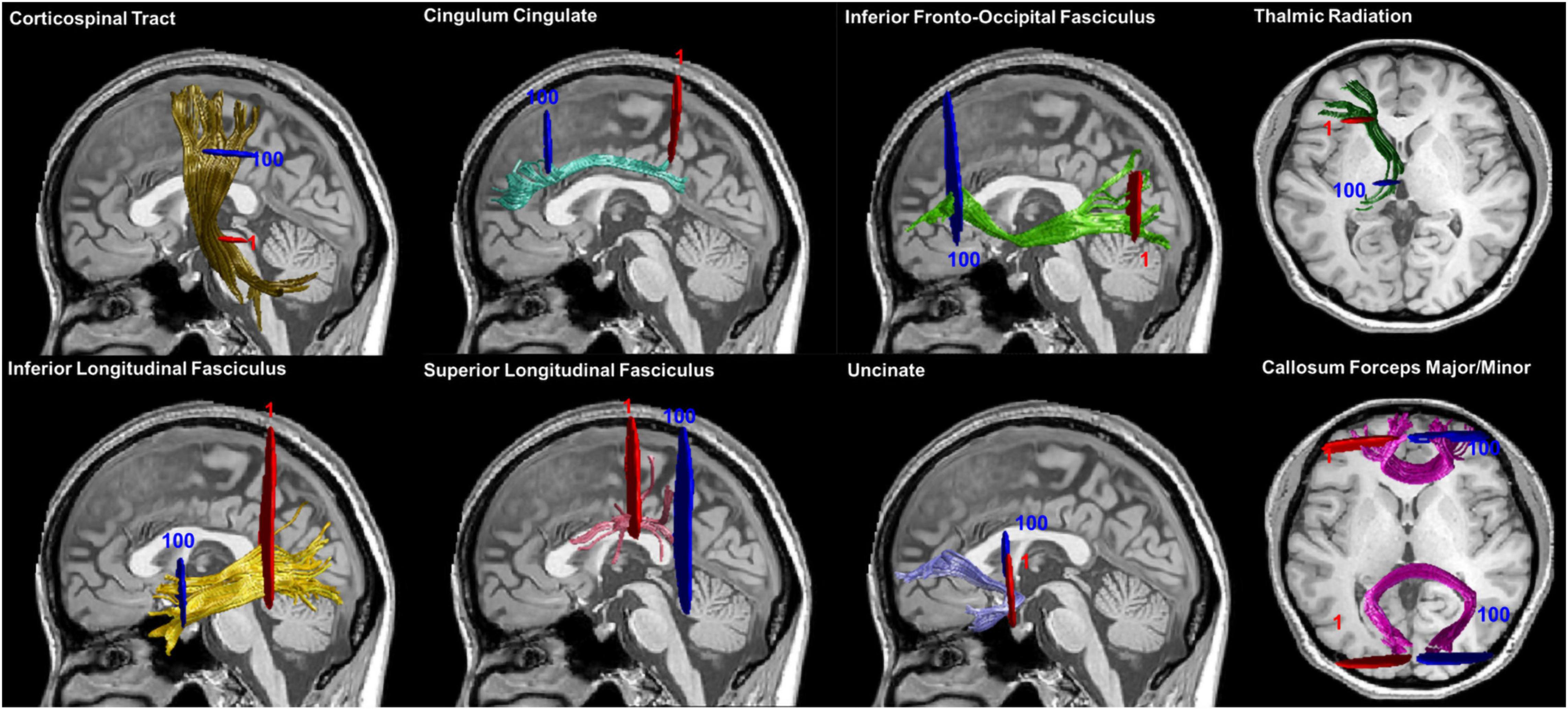 High-resolution 3D T1-weighted turbo fi eld echo imaging of the brain.