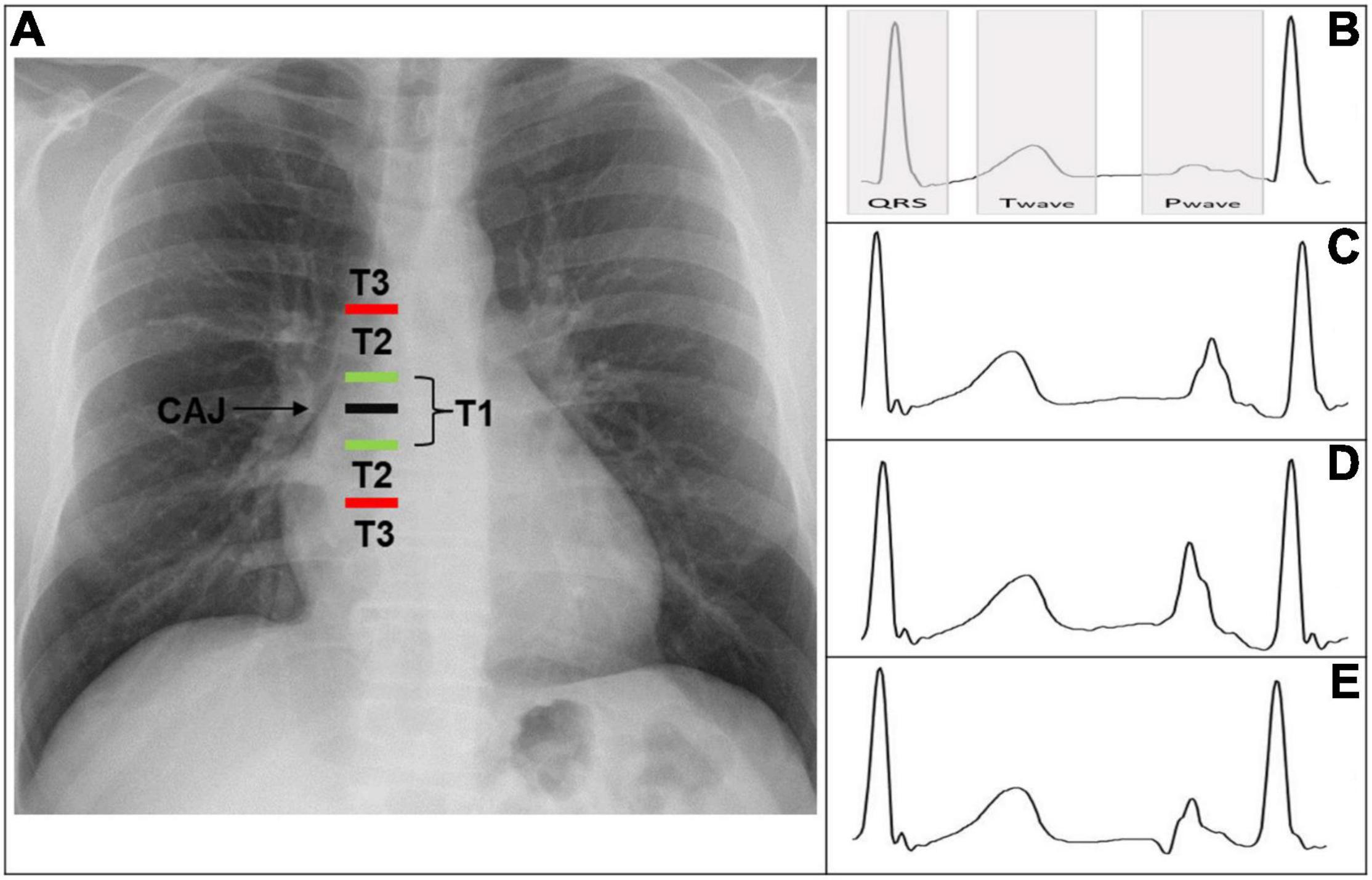 Frontiers  ECG-Based Techniques to Optimize Peripherally Inserted Central  Catheters: Rationale for Tip Positioning and Practical Use