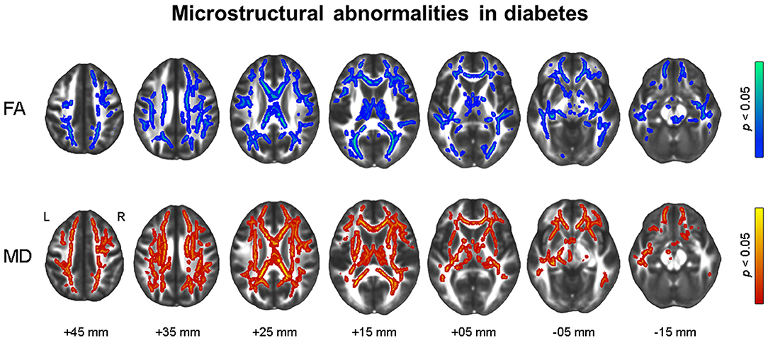 lsm.jpg4.us | imagesize: lsd-011 Frontiers | Brain Structural Alterations, Diabetes Biomarkers, and  Cognitive Performance in Older Adults With Dysglycemia