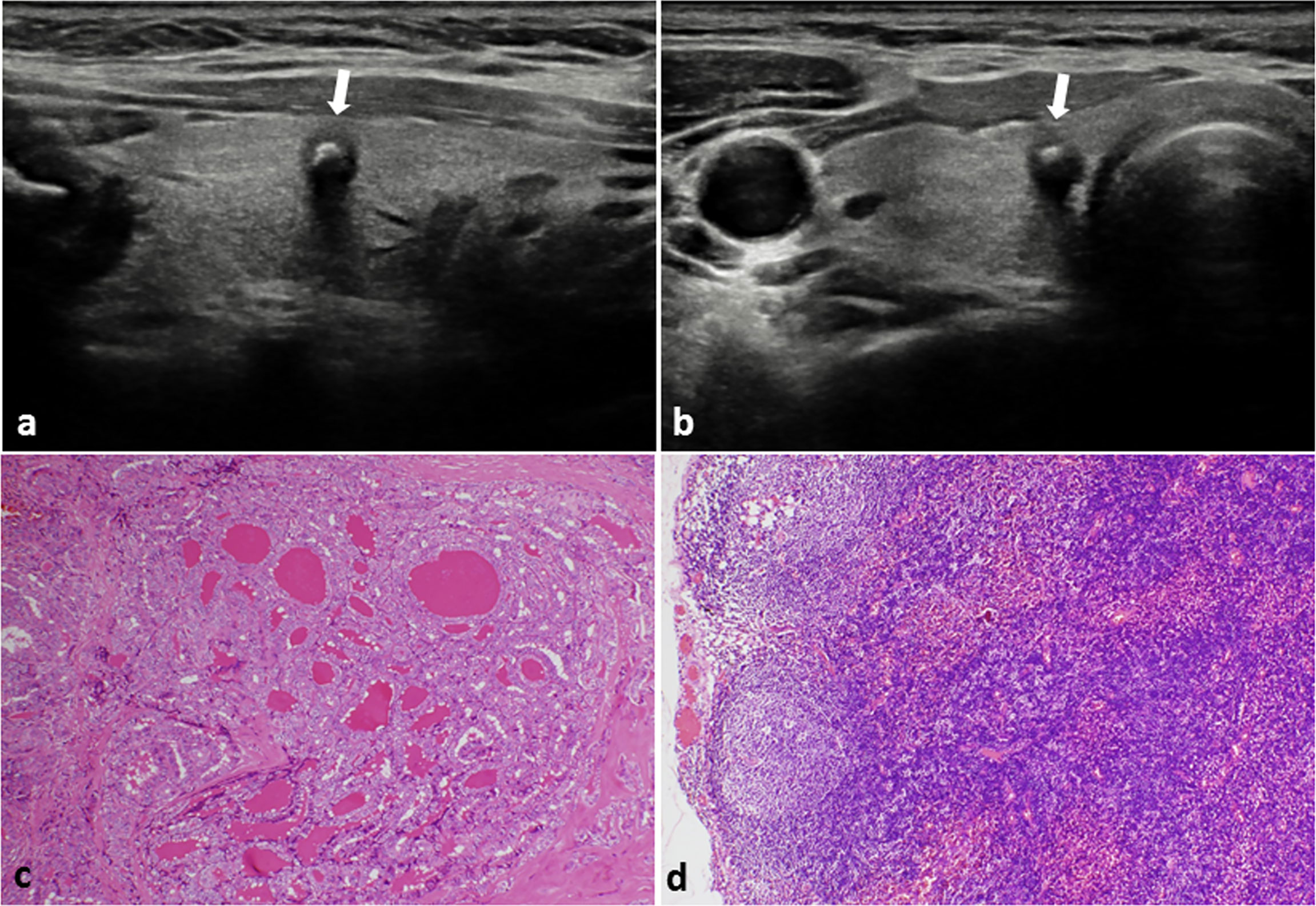 Frontiers Establishing A Predictive Nomogram For Cervical Lymph Node