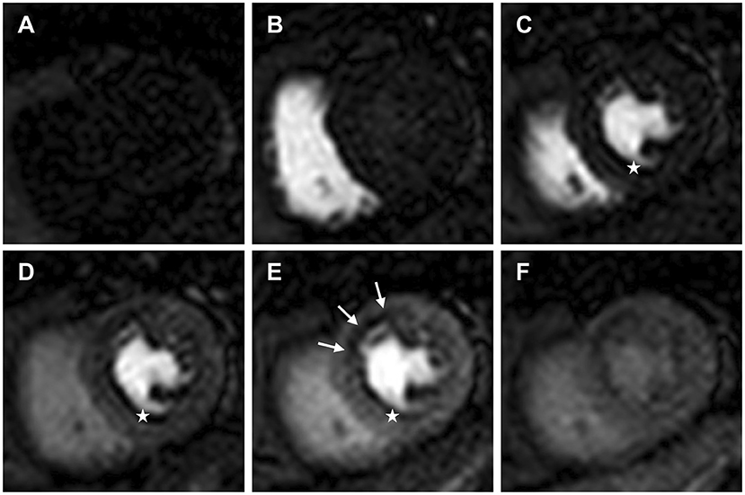 Frontiers | Clinical Application of Dynamic Contrast Enhanced Perfusion Imaging Magnetic Resonance