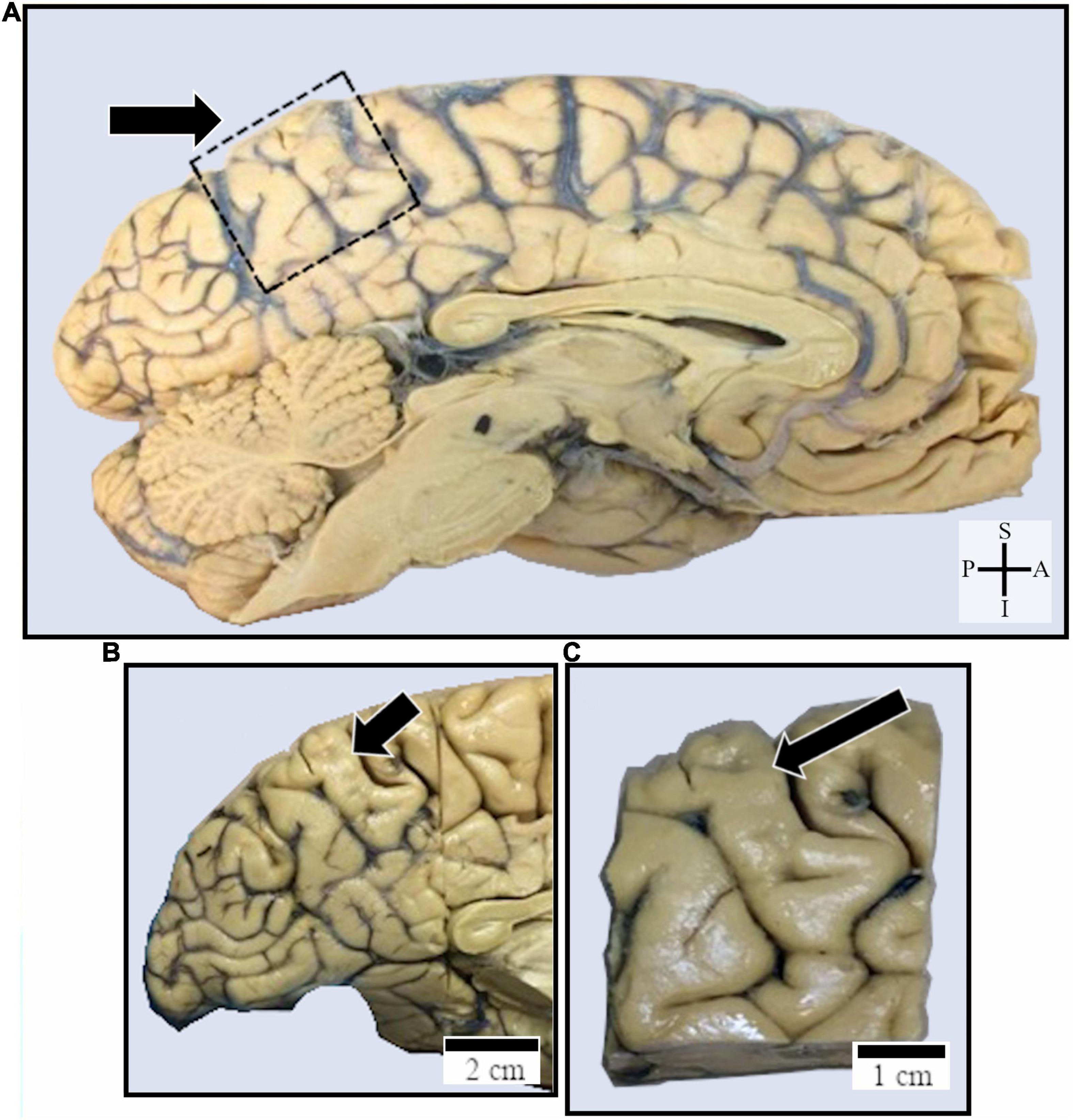 Study Identifies Cause for Excessive Folding of Gyri in Human