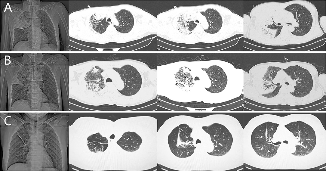 Aspiration Pneumonia: Symptoms, Causes, Diagnosis, and Treatment