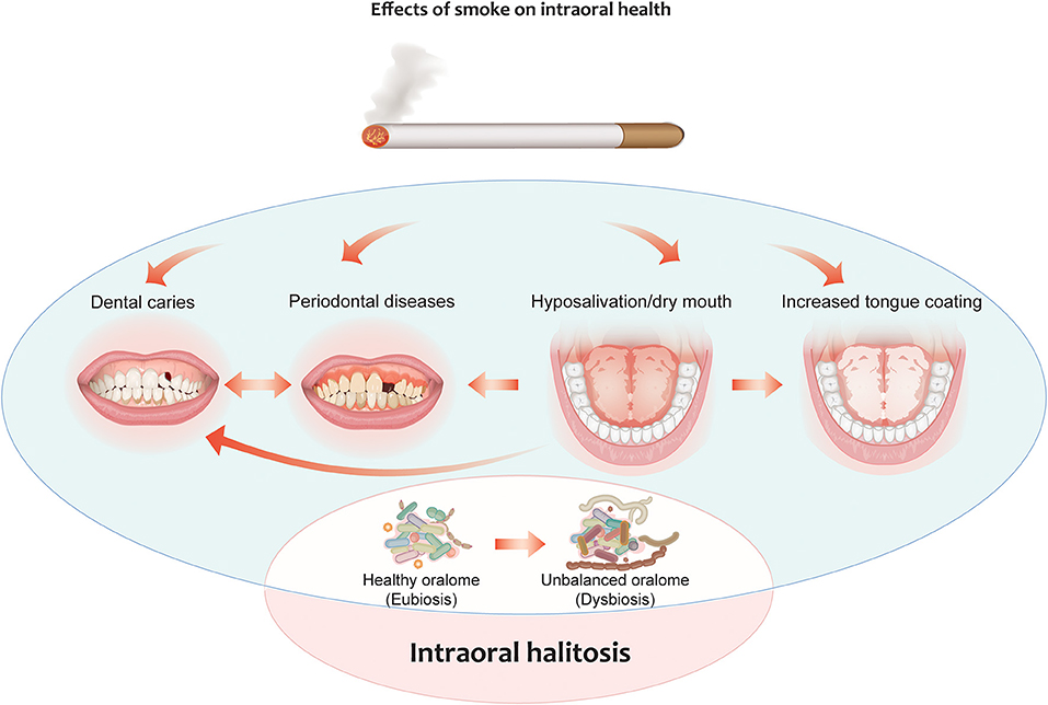 Cigarette Smoking Reduces Healthy Bacteria in the Mouth