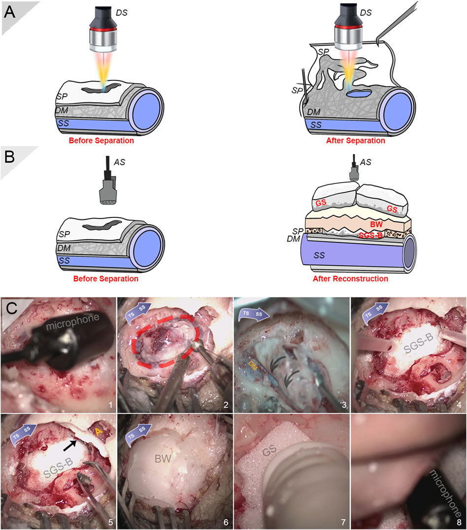 Frontiers Therapeutic Validation of Venous Pulsatile Tinnitus and Biomaterial Applications for Temporal Bone Reconstruction Surgery Using Multi sensing Platforms and Coupled Computational Techniques