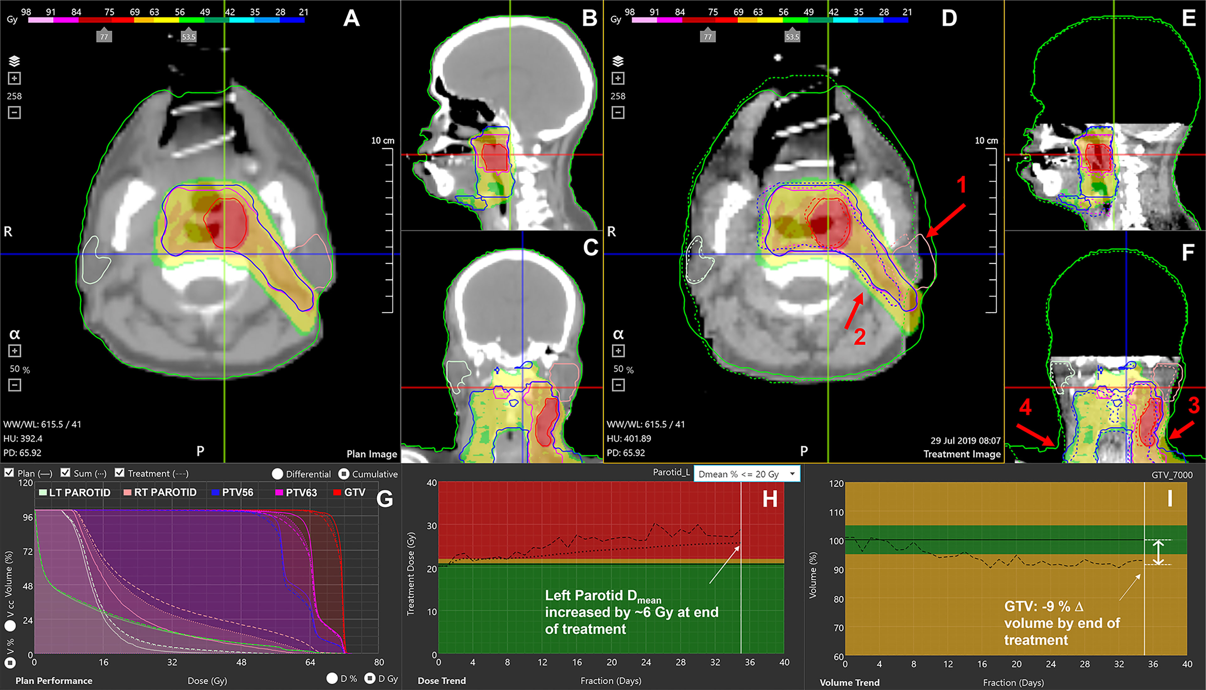 Frontiers  Retrospective Clinical Evaluation of a Decision-Support  Software for Adaptive Radiotherapy of Head and Neck Cancer Patients