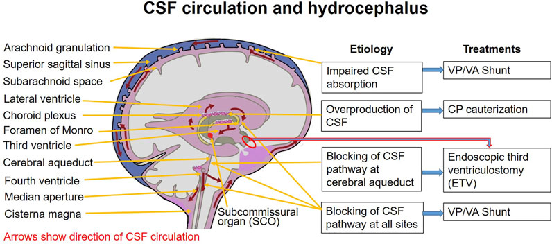 Choroid plexus mast cells drive tumor-associated hydrocephalus -  ScienceDirect