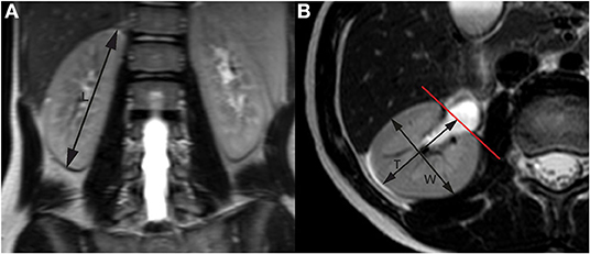 Frontiers A Comparability Of Renal Length And Volume Measurements In 