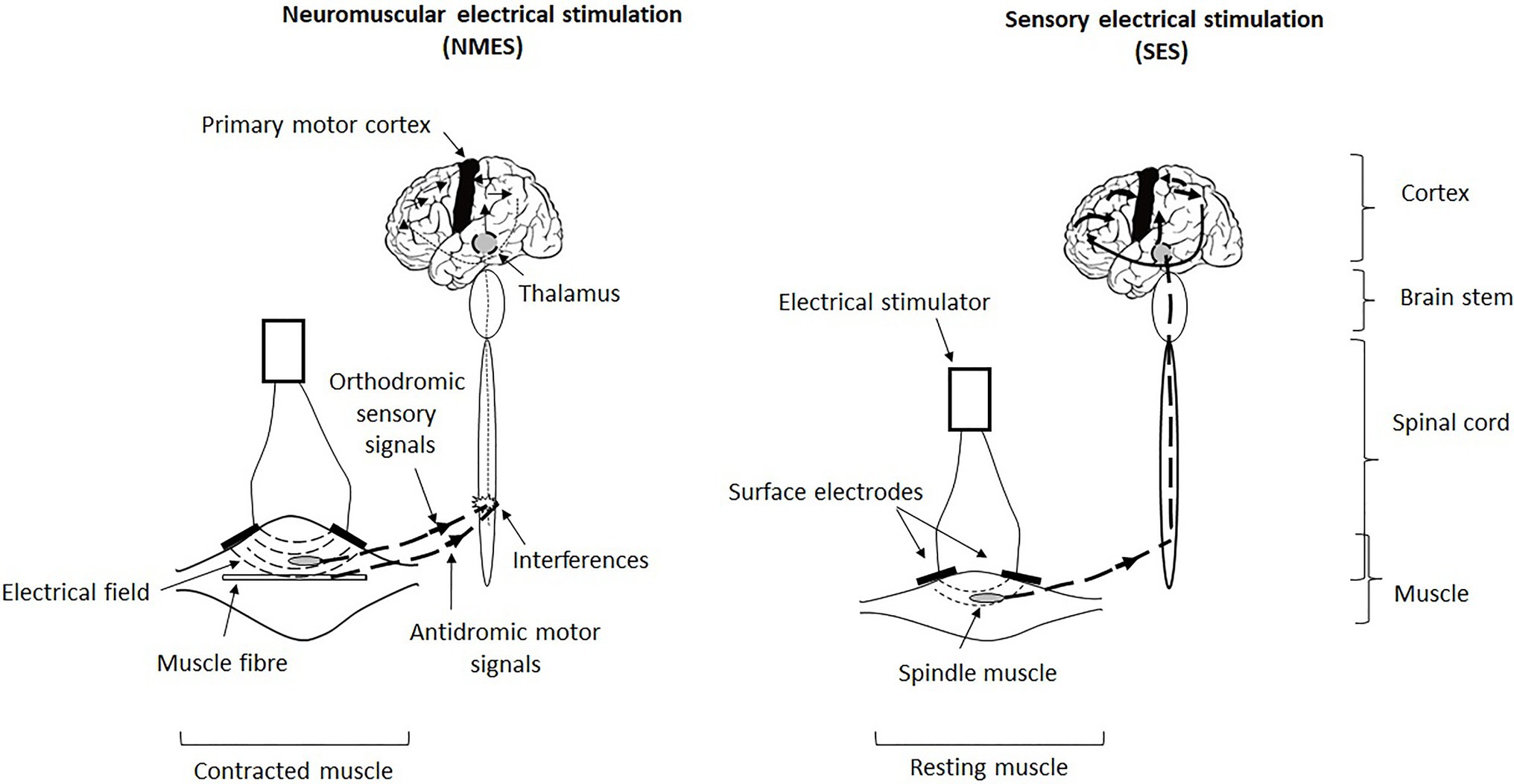 6 Electrical Muscle Stimulation Modalities for Return to Play