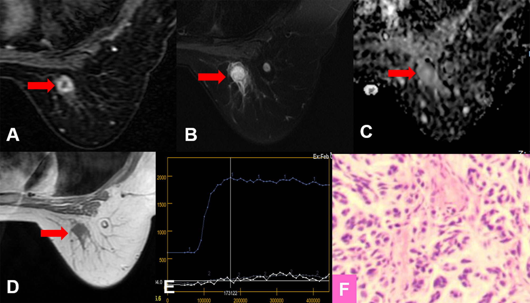 Frontiers  A Comparative Assessment of MR BI-RADS 4 Breast Lesions With  Kaiser Score and Apparent Diffusion Coefficient Value